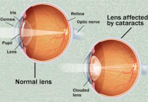 Cataract Surgery-A Century of Changes, Part I - Shepherd Eye Center